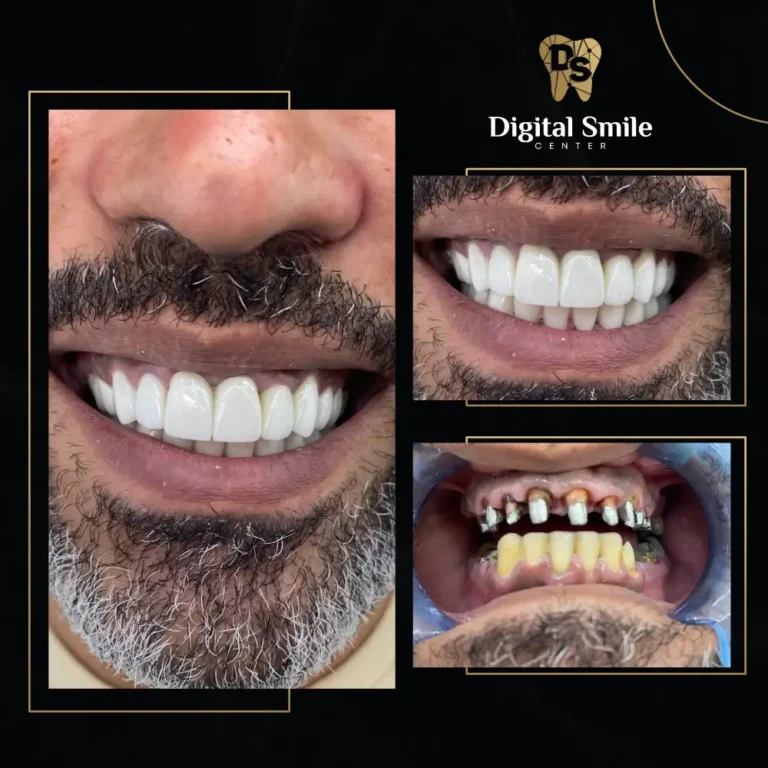 زراعة الأسنان قبل وبعد