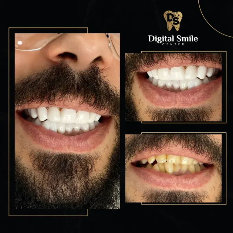 زراعة الأسنان قبل وبعد