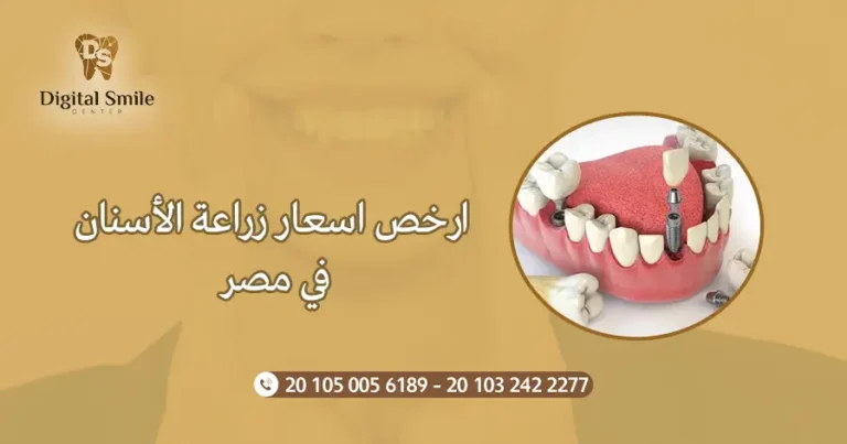 ارخص اسعار زراعة الأسنان في مصر