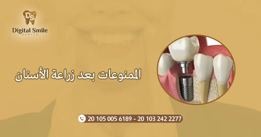 الممنوعات بعد زراعة الأسنان