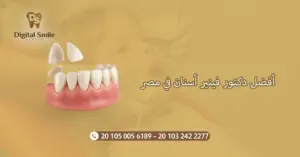 أفضل دكتور فينير أسنان في مصر: تجارب المرضى| ديجتال سمايل