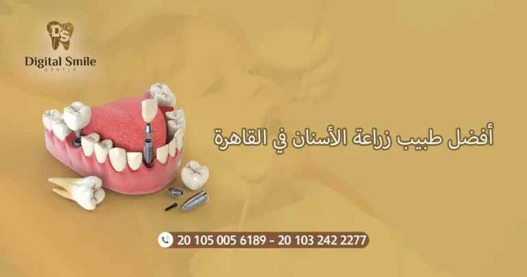 أفضل طبيب زراعة الأسنان في القاهرة: معايير التقييم والاختيار
