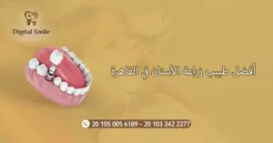  أفضل طبيب زراعة الأسنان في القاهرة: معايير التقييم والاختيار