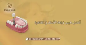  أفضل طبيب زراعة الأسنان في القاهرة: معايير التقييم والاختيار