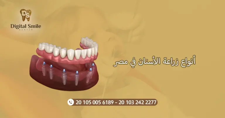 أنواع زراعة الأسنان في مصر: اختيار الأنسب لاحتياجاتك الصحية