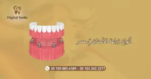 أنواع زراعة الأسنان في مصر: اختيار الأنسب لاحتياجاتك الصحية