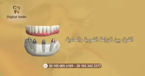 الفرق بين الزراعة الفورية والعادية : دليل شامل للمرضي