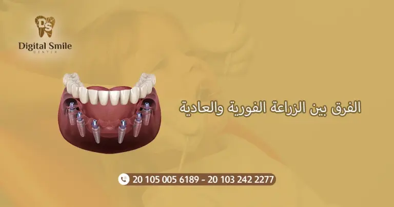 الفرق بين الزراعة الفورية والعادية : دليل شامل للمرضي