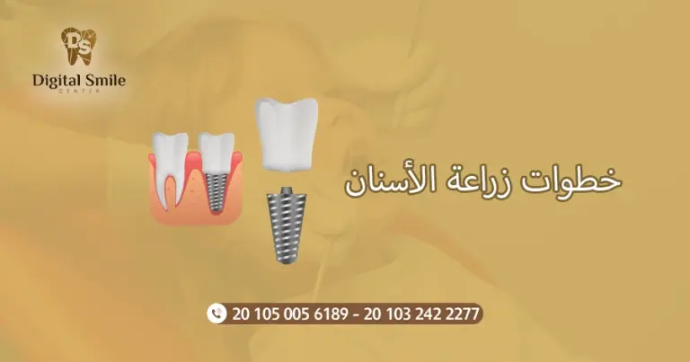 خطوات زراعة الأسنان: دليل شامل لتحقيق ابتسامة صحية وجميلة