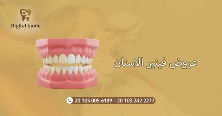 عروض فينير الاسنان: كيف تختار الأفضل لابتسامتك المثالية
