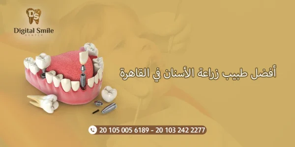 أفضل طبيب زراعة الأسنان في القاهرة: معايير التقييم والاختيار