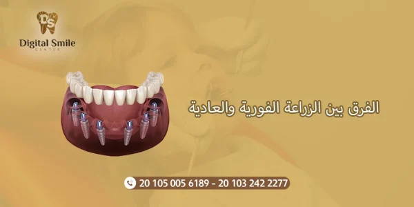 الفرق بين الزراعة الفورية والعادية : دليل شامل للمرضي